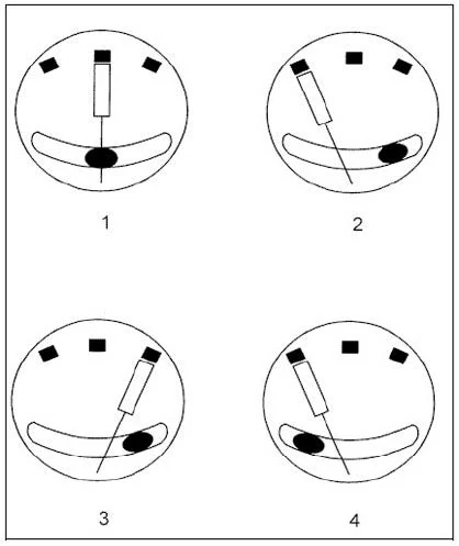 Aircraft General Knowledge - Instrumentation - The diagram representing a left turn with insufficient rudder is: